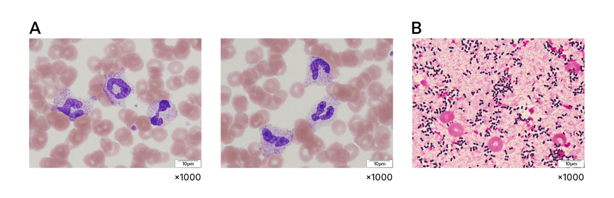 Şekil 3. (A) Hastanın periferik kan simiri, toksik nötrofil granülasyonu göstermiştir. (B) Kan kültürü (gram boyama), Staphylococcus aureus için pozitif test sonucu vermiştir.