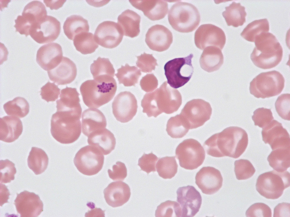 Streptococcal septicaemia Streptococcal septicaemia