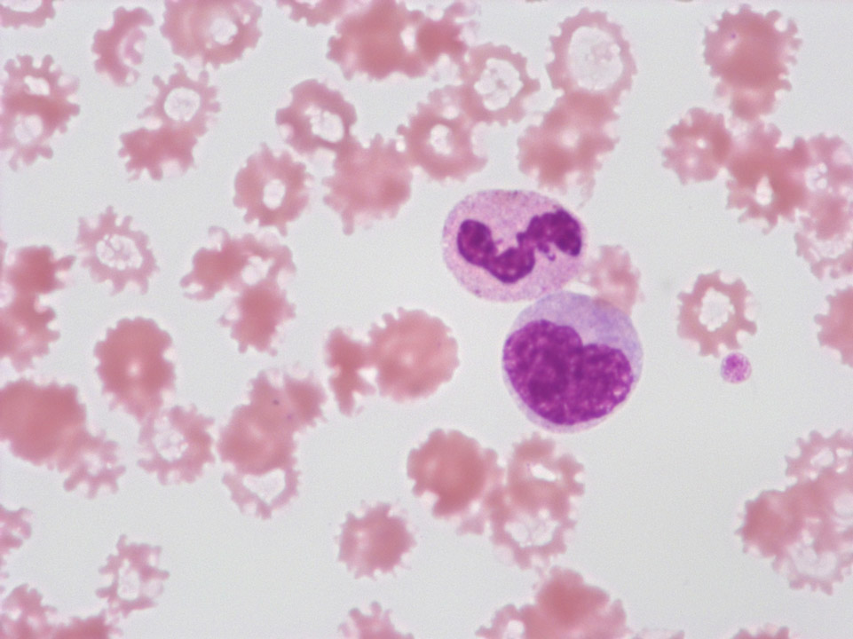 Acanthocytes Acanthocytes