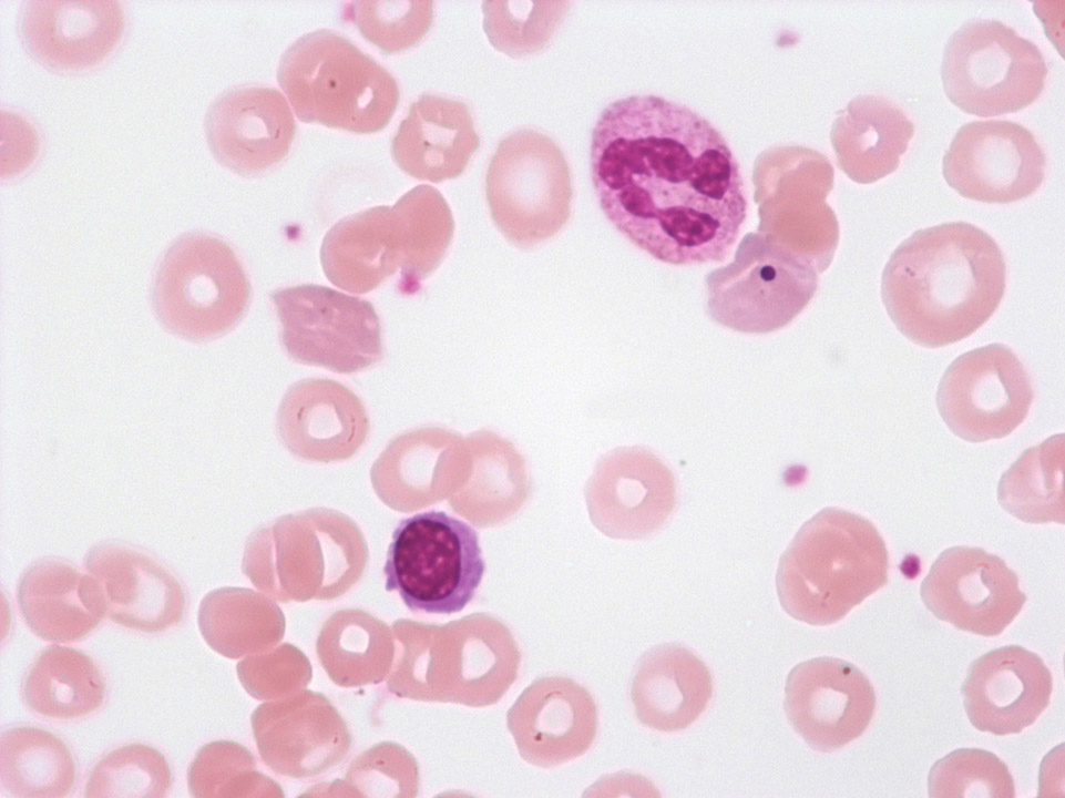 Howell-Jolly bodies Howell-Jolly bodies