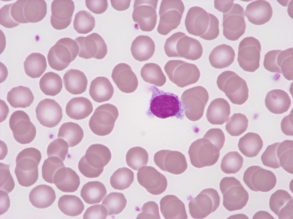 Hairy lymphocyte Hairy lymphocyte