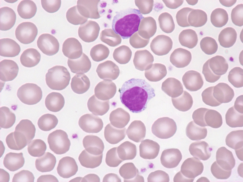 T-cell large granular lymphocytic (LGL) leukaemia T-cell large granular lymphocytic (LGL) leukaemia