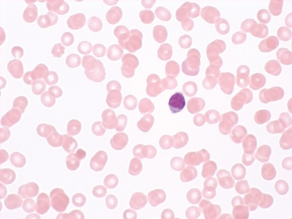Severe aplastic anaemia Severe aplastic anaemia