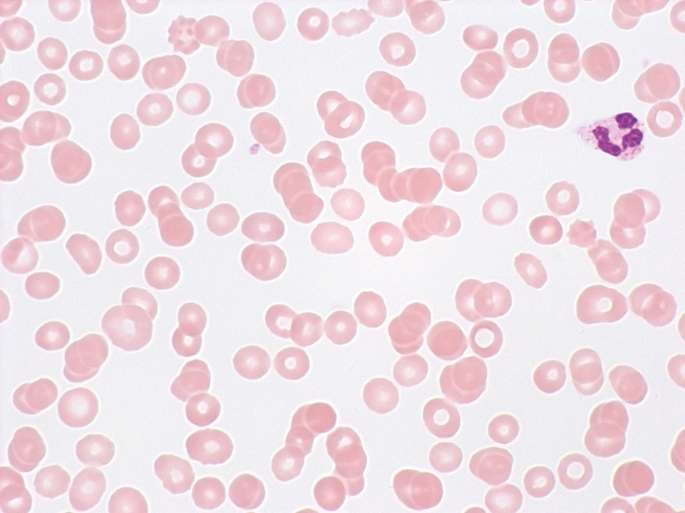 Severe aplastic anaemia Severe aplastic anaemia