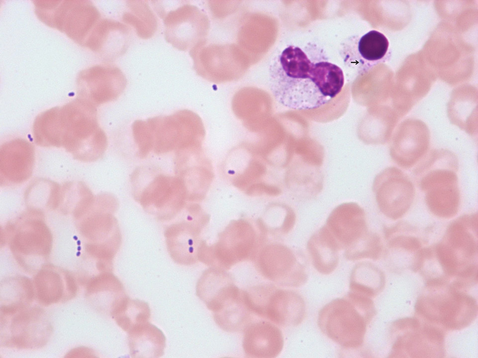 Streptococci in blood film Streptococci in blood film