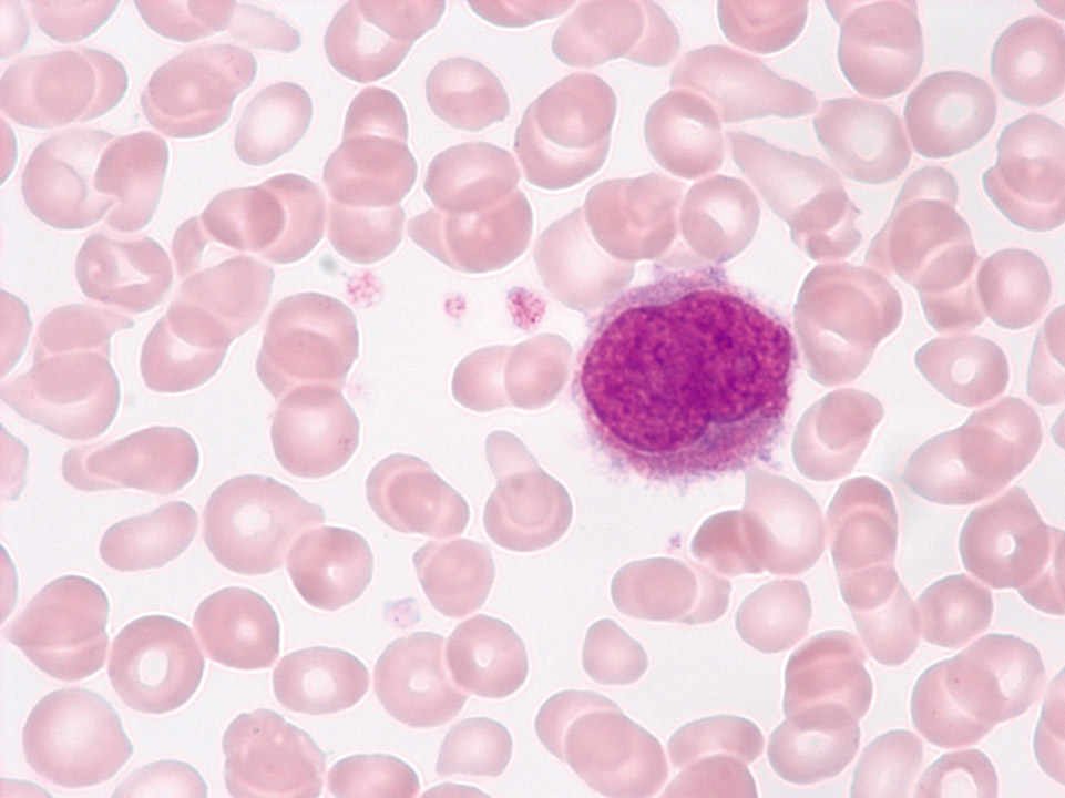 Primary myelofibrosis (PMF) Primary myelofibrosis (PMF)