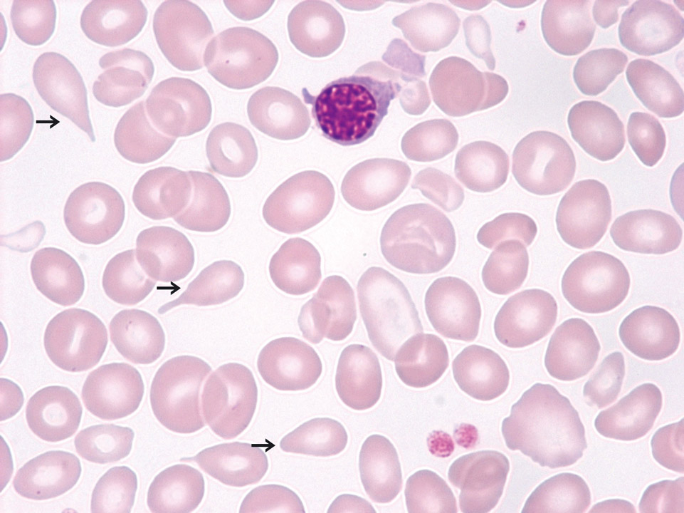 Primary myelofibrosis (PMF) in fibrotic stage Primary myelofibrosis (PMF) in fibrotic stage