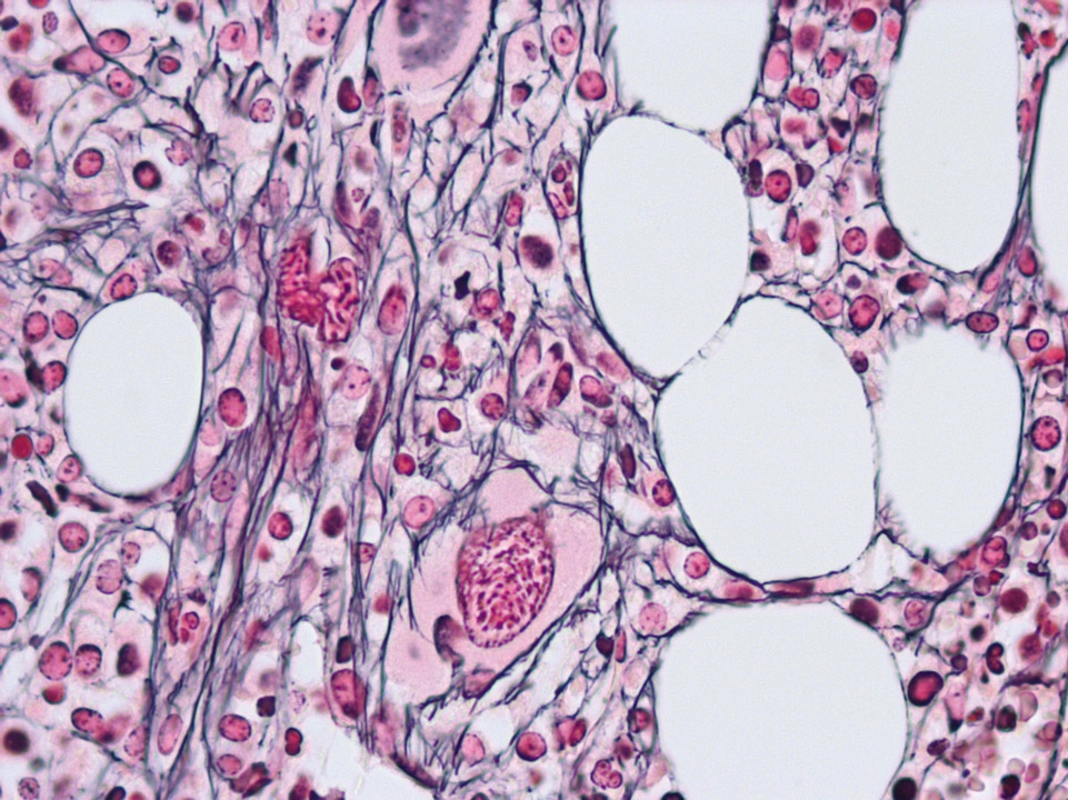 Primary myelofibrosis (PMF) in bone marrow histology Primary myelofibrosis (PMF) in bone marrow histology