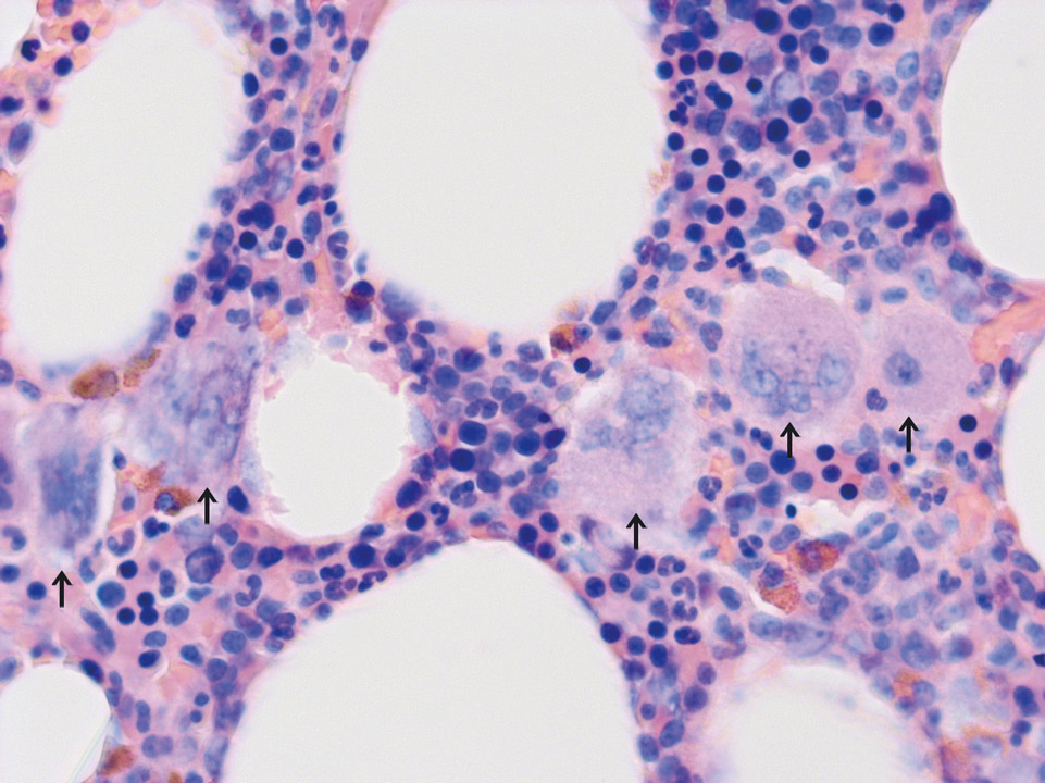 Abundant and atypical megakaryocytes Abundant and atypical megakaryocytes