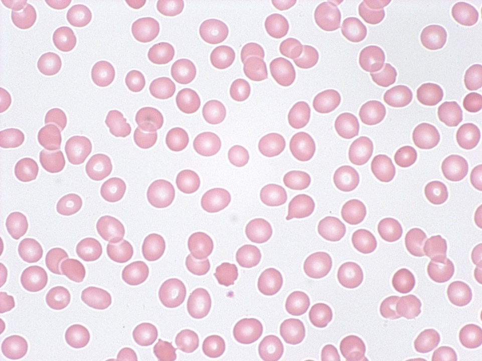 Pancytopenia (tricytopenia) in peripheral blood Pancytopenia (tricytopenia) in peripheral blood