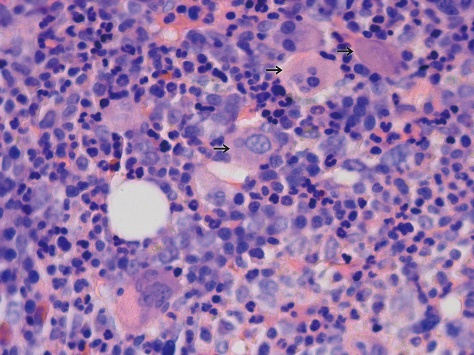 High number of megakaryocytes High number of megakaryocytes