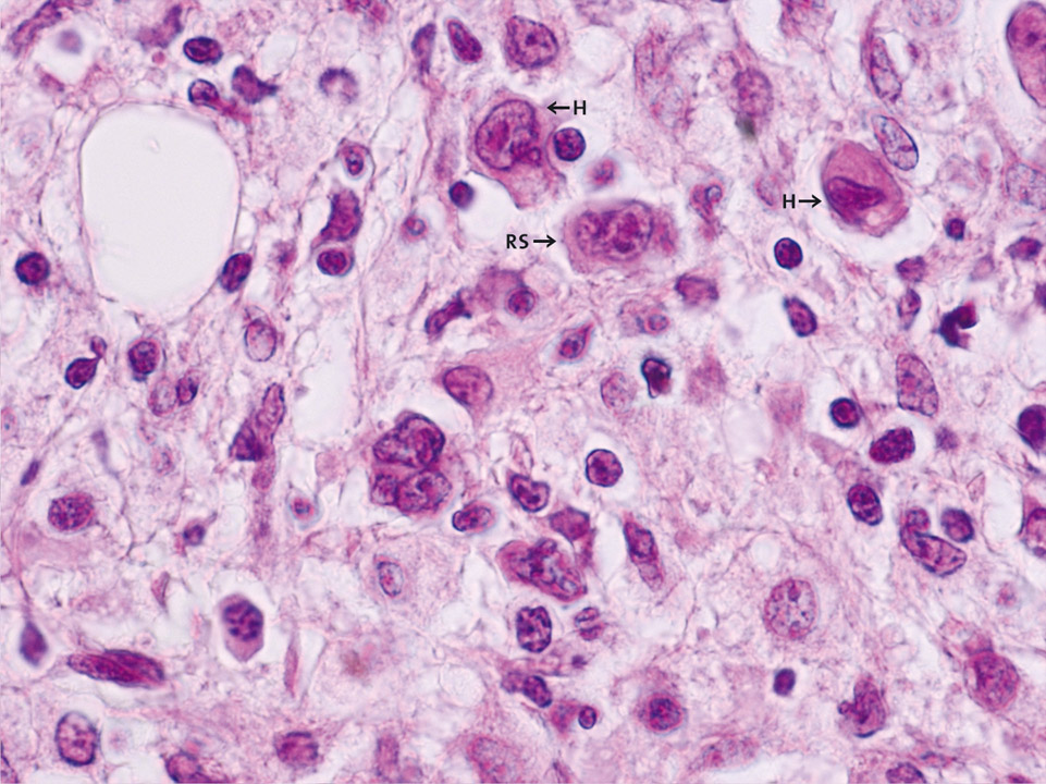 Hodgkin cells Hodgkin cells
