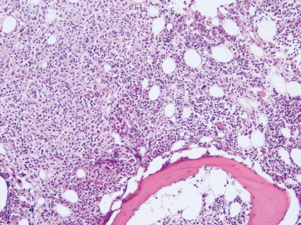 Hodgkin's lymphoma Hodgkin's lymphoma