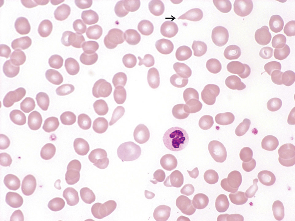 Macrocytic, hyporegenerative anaemia Macrocytic, hyporegenerative anaemia