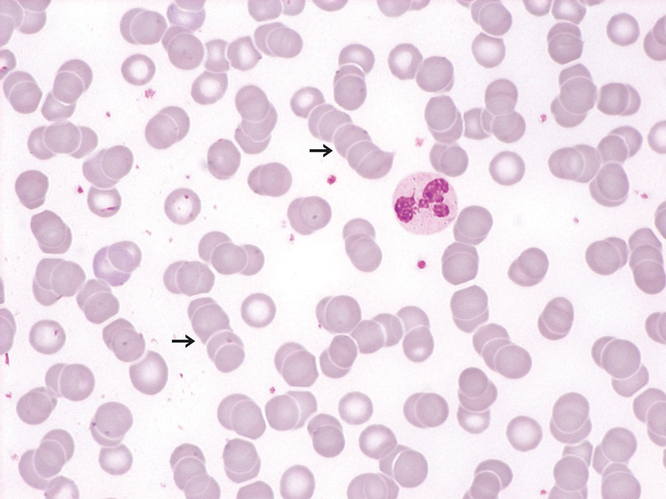 'Rouleaux formation' of red blood cells