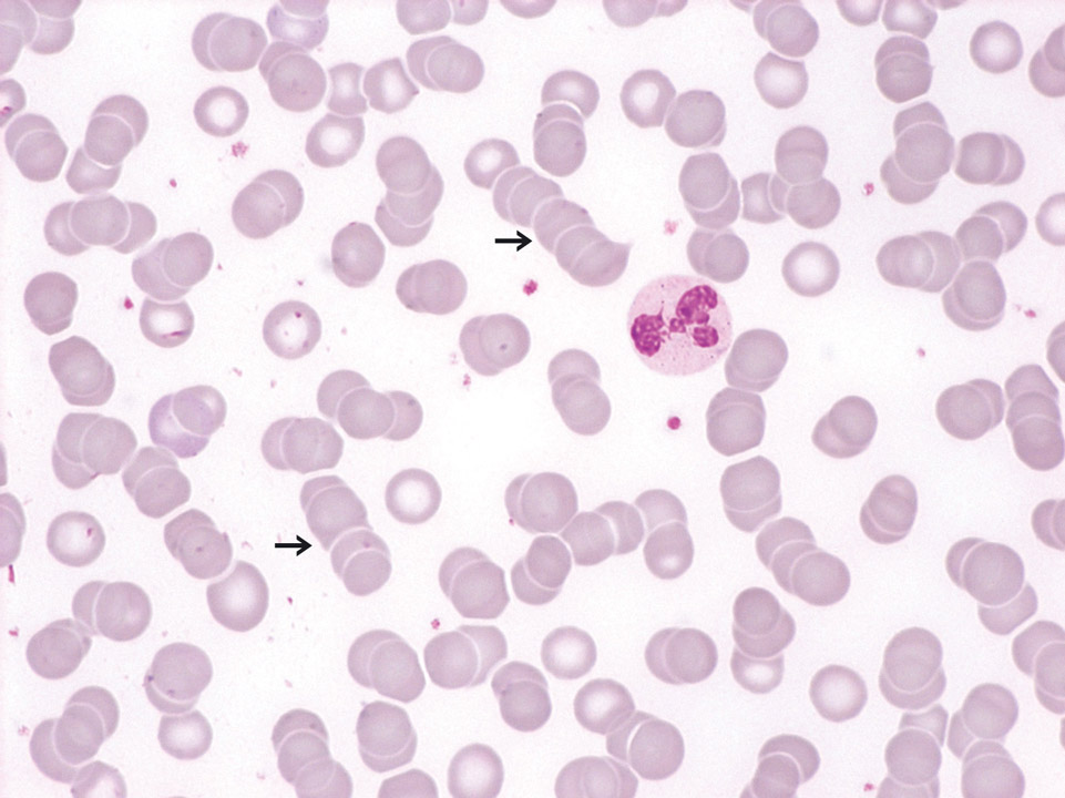 'Rouleaux formation' of red blood cells 'Rouleaux formation' of red blood cells