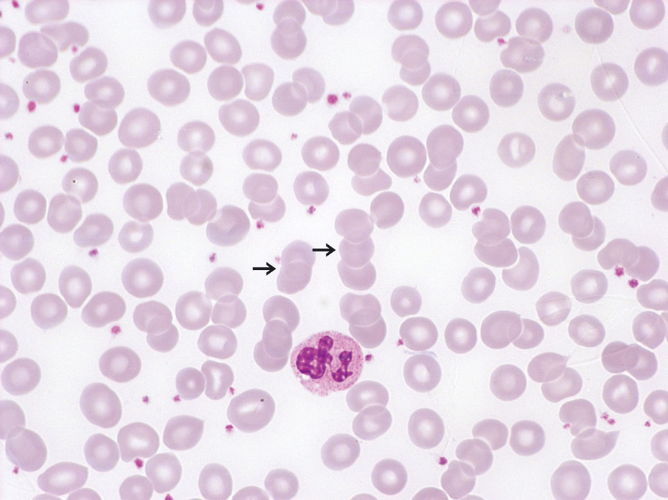 'Rouleaux formation' in blood of a patient with chronic polyarthritis 'Rouleaux formation' in blood of a patient with chronic polyarthritis