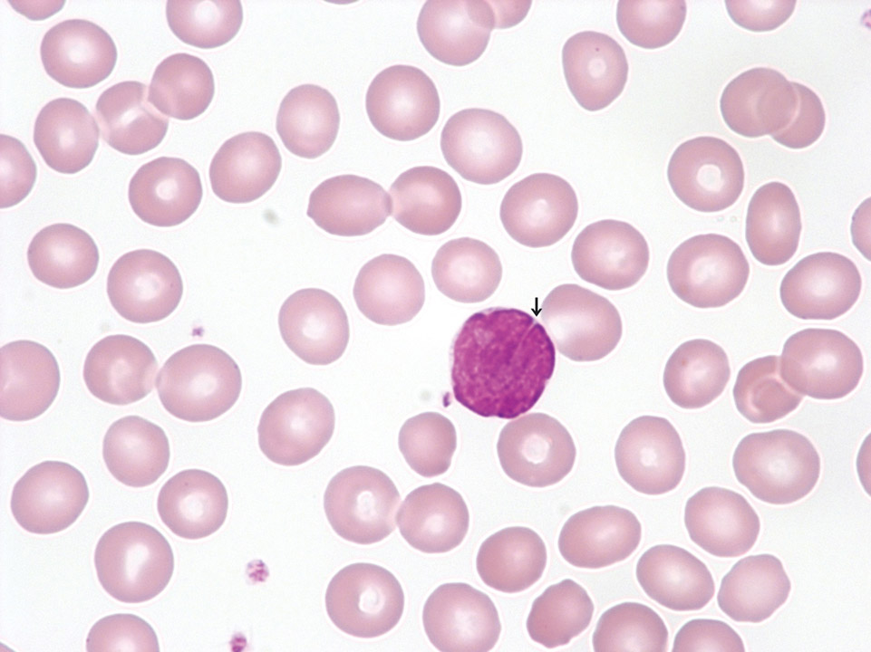 Lymphoma cells in peripheral blood Lymphoma cells in peripheral blood