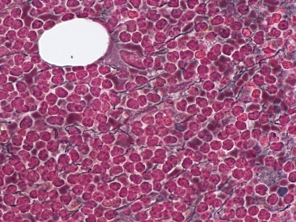 Mantle cell lymphoma infiltrating bone marrow Mantle cell lymphoma infiltrating bone marrow