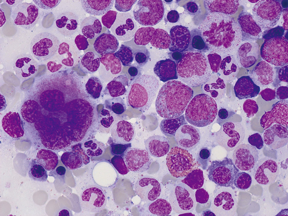 Normal bone marrow cytology Normal bone marrow cytology