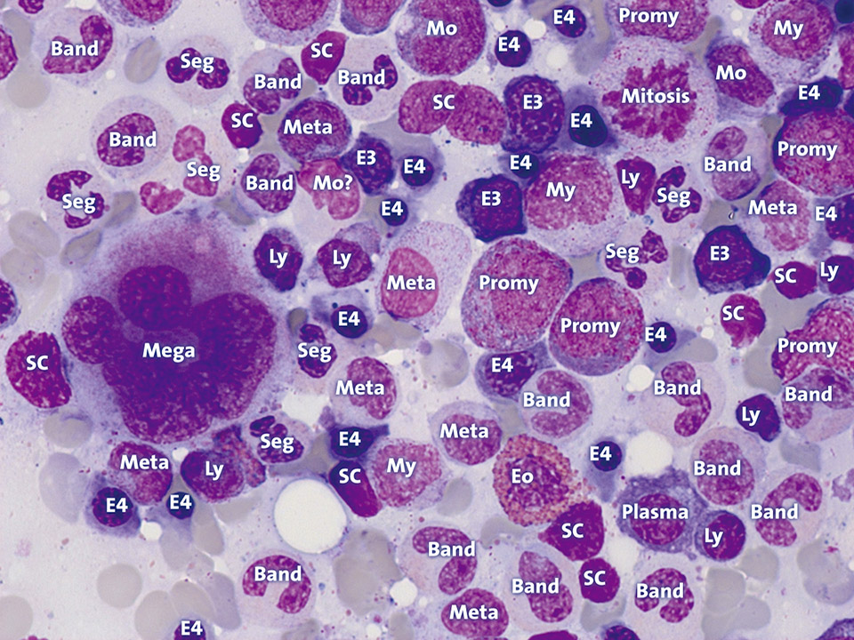 Normal bone marrow cytology Normal bone marrow cytology