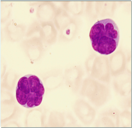 Sézary cells Sézary cells